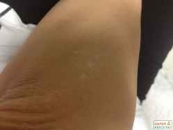 白癜风治疗