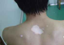 白癜风治疗
