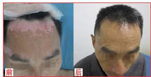 10年白癜风,康复不再是梦