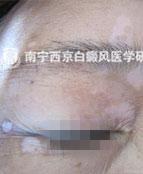 退休老教师告别白斑,享受幸福晚年生活