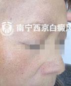 退休老教师告别白斑,享受幸福晚年生活