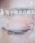 退休老教师告别白斑,享受幸福晚年生活