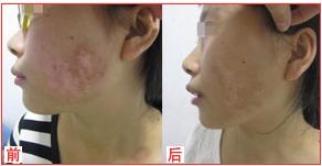 个性化治疗,10岁白癜风女孩获得康复1.jpg